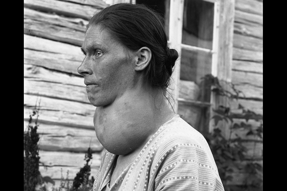 Kone med stor struma (1) (2)